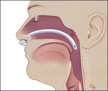 Nasopharyngeal Airway