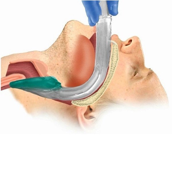 Laryngeal Mask Airway